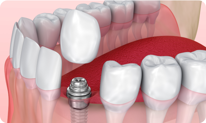 痛み、腫れが少なく、治療期間が短い抜歯即時埋入インプラント