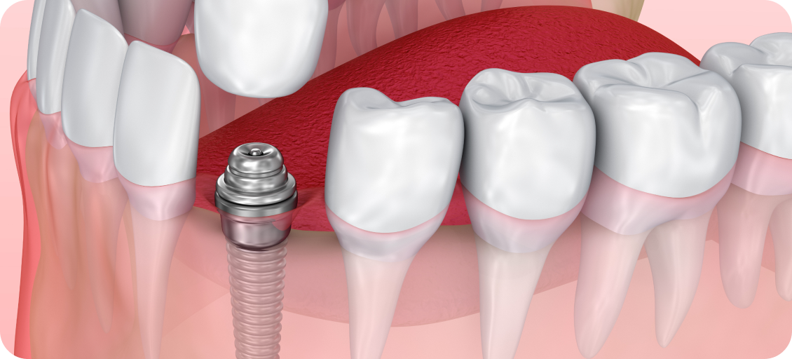 痛み、腫れが少なく、治療期間が短い抜歯即時埋入インプラント